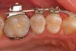 restaurierter Zahn